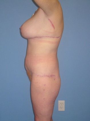 Body Contouring After Weight Loss Female Before & After Image