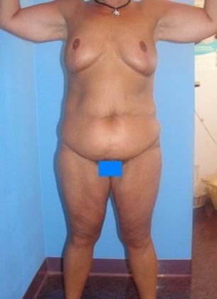 Body Contouring After Weight Loss Female Before & After Image