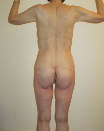 Thighplasty Before & After Image